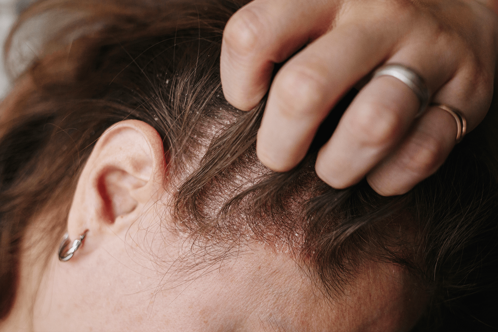 5 skutecznych sposobów na suchą skórę głowy zimą