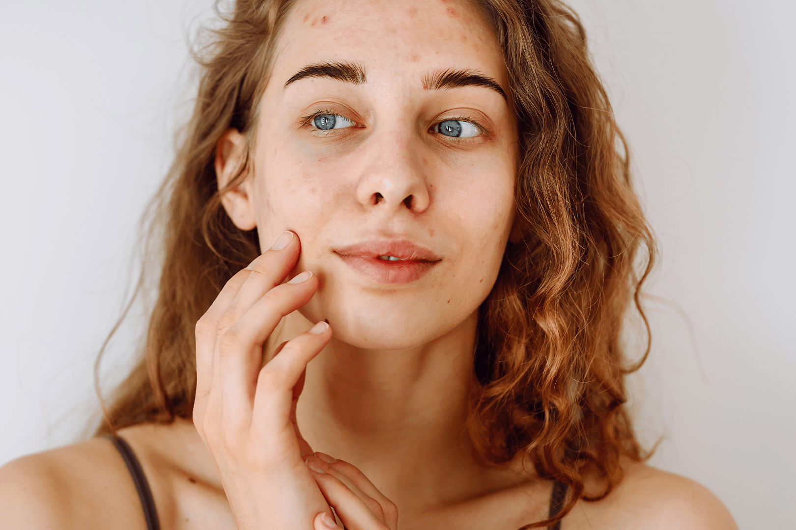 Jak radzić sobie z trądzikiem hormonalnym w naturalny sposób?