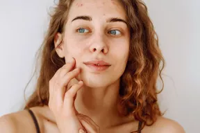 Jak radzić sobie z trądzikiem hormonalnym w naturalny sposób?